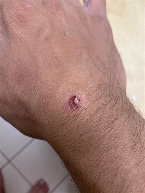 Wart Removal Band Aid Process at Jorge Damon blog
