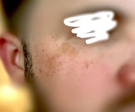 [product request] Dark sun spots on face. What are my options? : r/SkincareAddiction