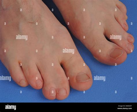 Human webbed feet hi-res stock photography and images - Alamy