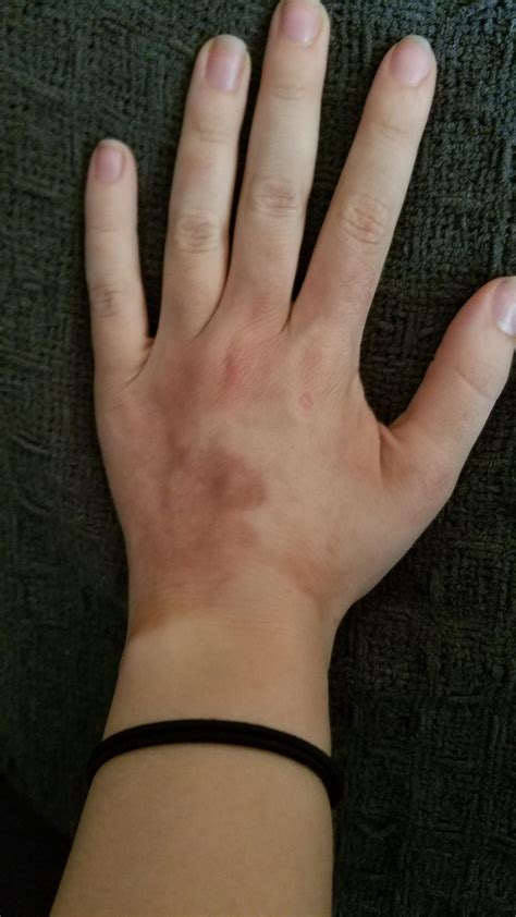 Fingers Dark Marks at Adriana Fishburn blog