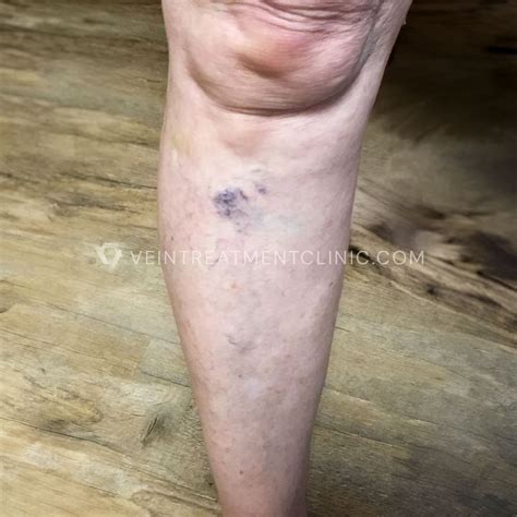 What Are Varicose Veins? | Definition, Causes & Meaning | Vein ...