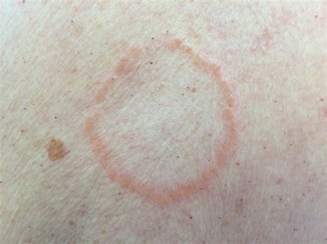Granuloma Annulare: Overview | Granuloma Annulare: Overview, Diagnosis and Treatment – ZFCZBQ