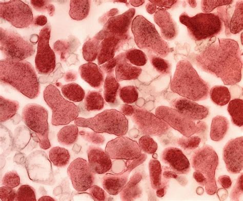 Mycoplasma genitalium, transmission, signs, symptoms, diagnosis & treatment