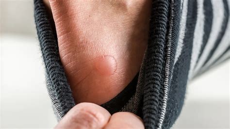 Should You Pop a Blister? How to Safely Treat Blisters at Home - GoodRx