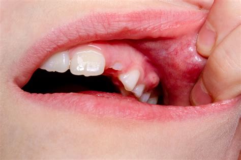 Gum Boil: Causes, Symptoms, and Treatments | Oral-B UK