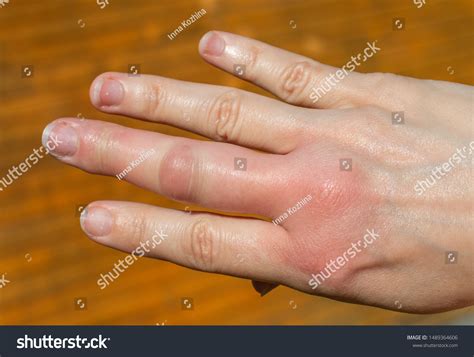 Bee Sting Swelling