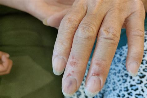 Snapping Turtle Bite Marks