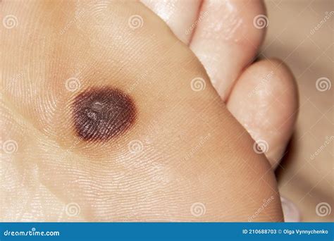 Plantar Wart On Foot Black Dots at Isabelle Odonovan blog