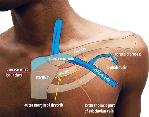 Subclavian Vein Central Line Landmarks