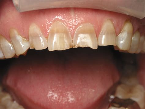 Stained Capped Teeth at Lucy Sutcliffe blog