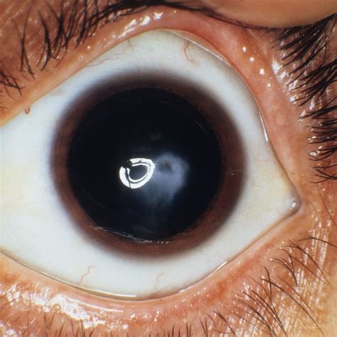 Keratoconus symtoms, causes, and diagnosis | Lenses for Keratoconus