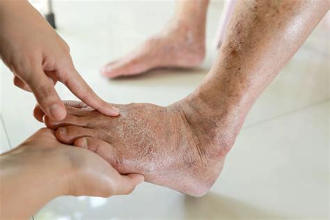 Xerosis for Philadelphia, PA | Frankford Podiatry Associates, PC | Board Certified Podiatrists ...
