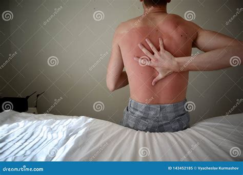 Itchy Skin After Sunburn at Caitlyn Lavater blog