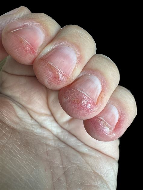 Allergic contact dermatitis to isobornyl acrylate in a home nail glue ...