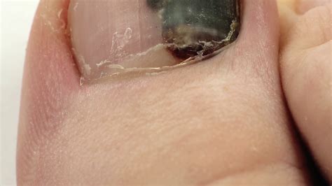 Hematoma Toenail