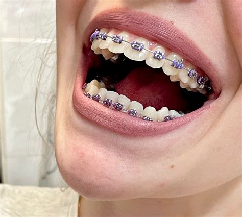 Dental Braces Colors, Pink Braces, Cute Braces Colors, Braces Cost ...