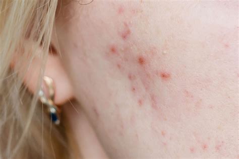 A Dermatologist’s Role in Cystic Acne Treatment