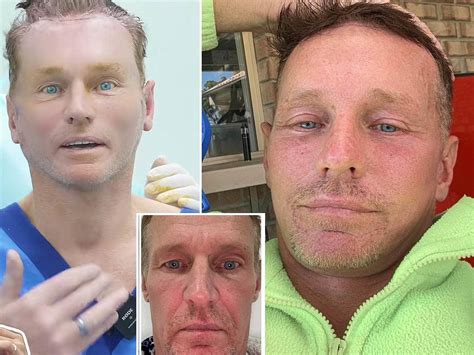 Australian man becomes 'famous' after undergoing cosmetic surgery in ...