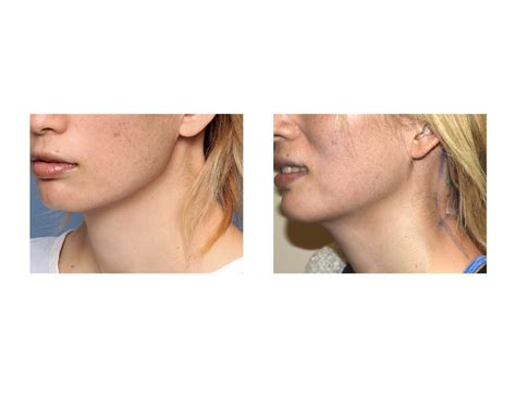 Plastic Surgery Case Study - Webbed Neck Correction Surgery - Explore ...