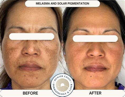 Before & After - Melasma & Pigmentation - Hunter Coast Dermatology & Laser