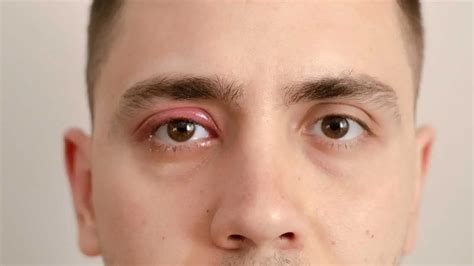 What Is Orbital Cellulitis? Causes, Symptoms & Treatment