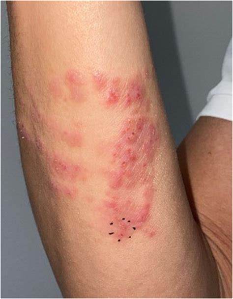 Box Jellyfish Sting Scars