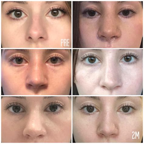List 105+ Pictures Rhinoplasty Recovery Photos Day By Day Updated