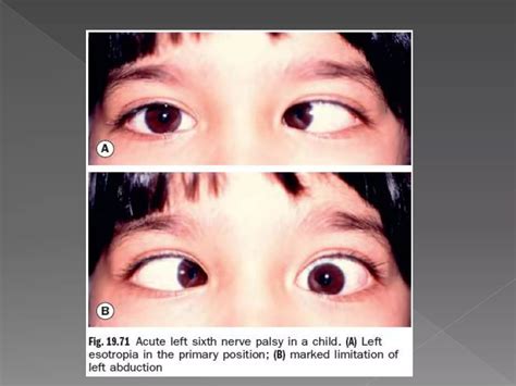 3rd, 4th, & 6th cranial nerve palsy | PPTX