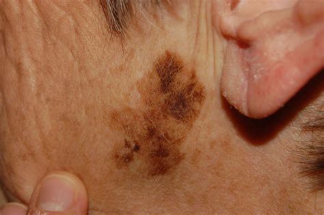 Skin Cancer Moles On Scalp
