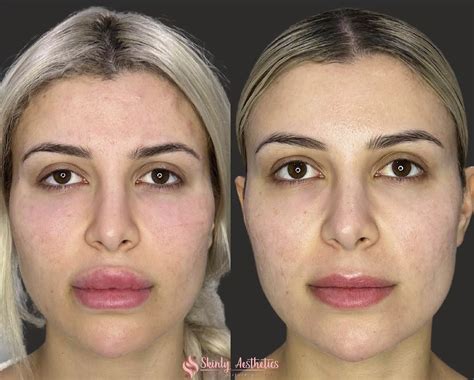 Dissolving Dermal Fillers With Hyaluronidase | Skinly Aesthetics