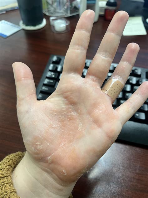 Dupixent : r/Dyshidrosis
