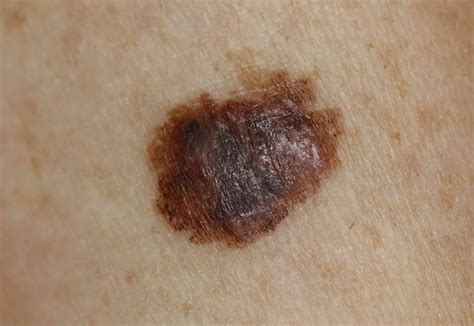 Nodular Melanoma Skin Cancer malignant melanoma - Skin Cancer Pictures - skinetix