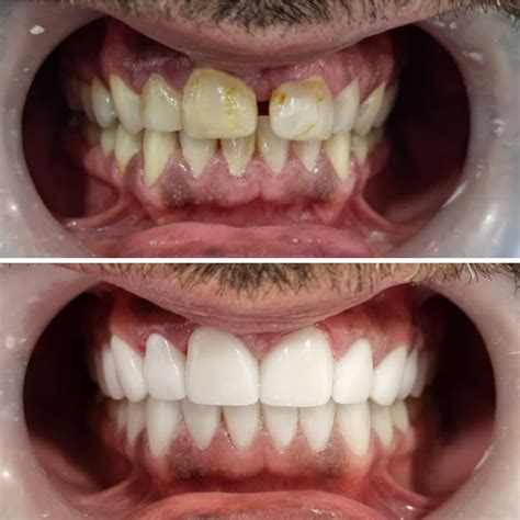 Why Colombia is the best place to get porcelain veneers abroad - Dental Tourism Colombia
