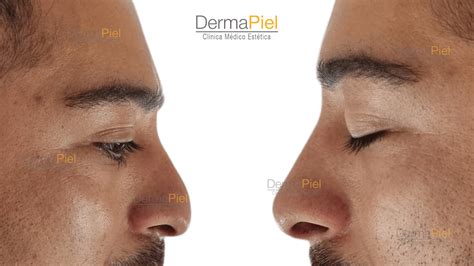 Cirugía De Nariz Para Hombres Qué Tipos De Rinoplastia Existen?