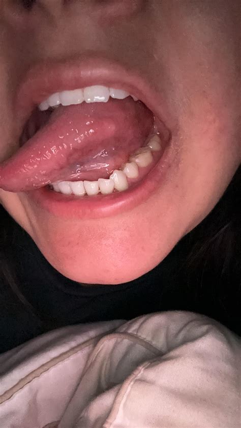 Bump On Side Of Tongue