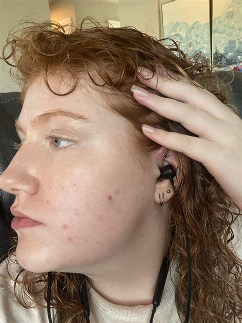 I’ve figured out my chin acne is caused by hormones (I pick so I’m working on that), but how can ...