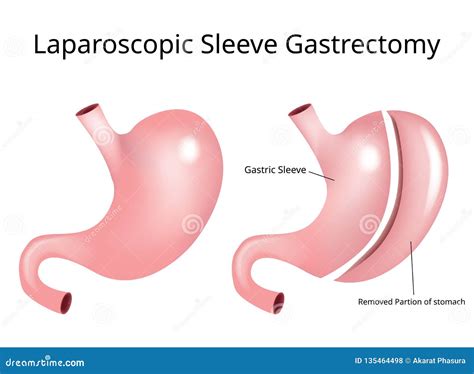Laparoscopic Sleeve Gastrectomy / Weight Loss Surgery - Vector Stock Illustration - Illustration ...