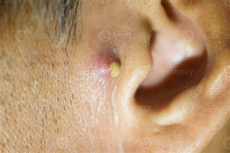 Pus coming from nodular cystic acne in front of the man ear 35167255 ...