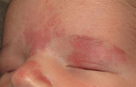Vascular Anomalies and Other Cutaneous Congenital Defects - Clinical Tree