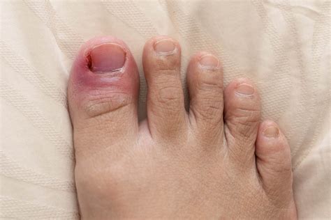 Sore Great Toe
