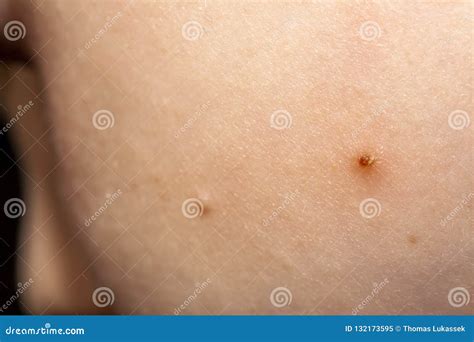 Close Up of Molluscum Contagiosum Also Called Water Wart Stock Image ...