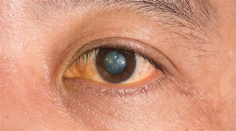 Peripheral Vision Loss: Causes and Solutions