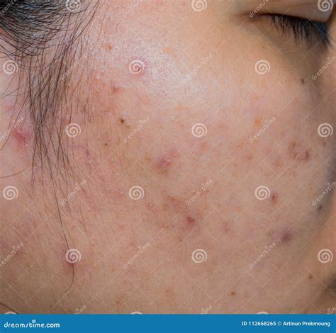 Comedonal Acne Cheeks