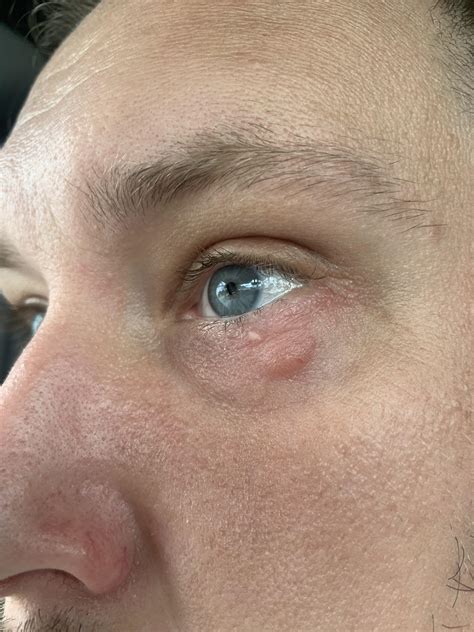 Fluid filled bump under my eye appeared this morning. : r/Dermatology