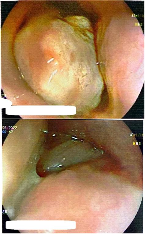 A giant quiet esophageal polyp: A case report - Sadidi - 2023 - Clinical Case Reports - Wiley ...