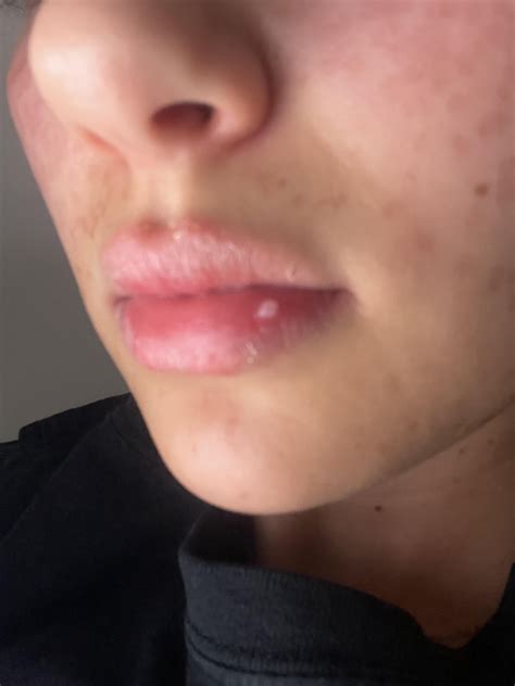 white bump on lip won’t go away : r/DiagnoseMe