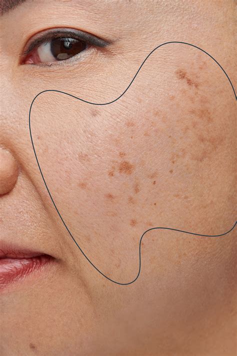 Dark Spots On Face