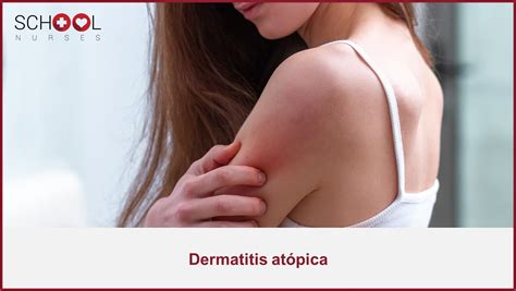 Dermatitis atópica. Qué es, causas y síntomas - School Nurses