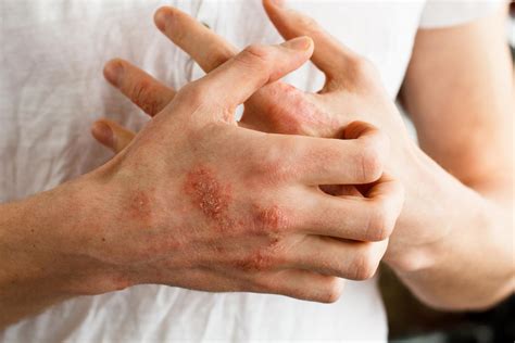 Is Eczema Contagious? Myths, Truths & Advice