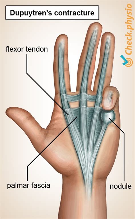 Dupuytren's contracture | Physio Check